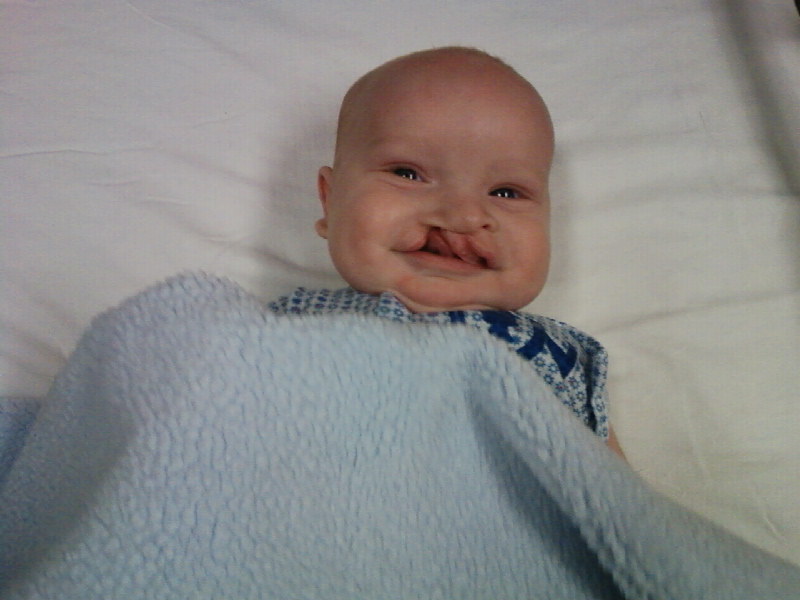 Ethan's First Surgery